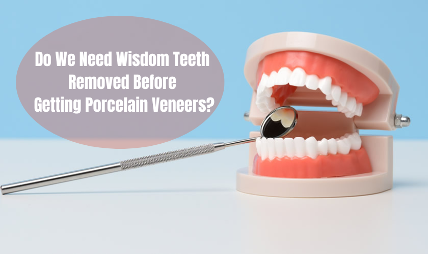 Do We Need Wisdom Teeth Removed Before Getting Porcelain Veneers