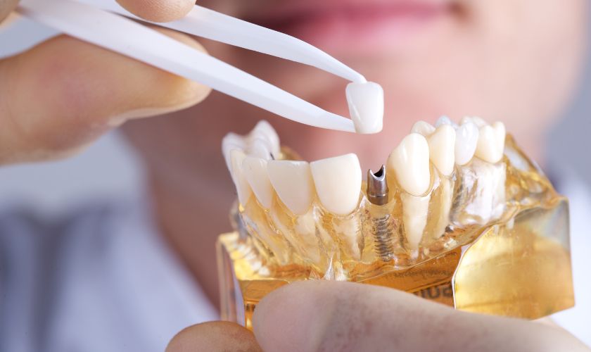 How long dental implants last