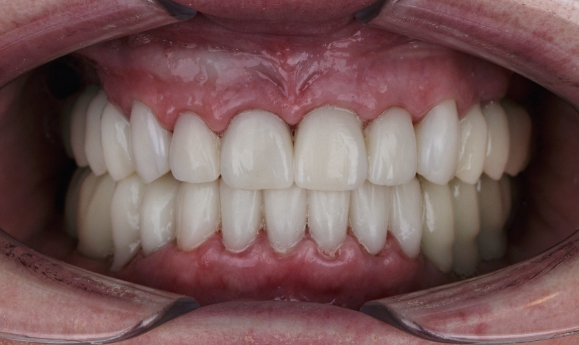 Revamp Your Smile: Top 10 Ways to Achieve Complete Restoration