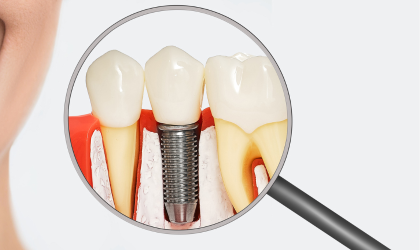 Insurance Coverage for Dental Implants: What You Need to Know