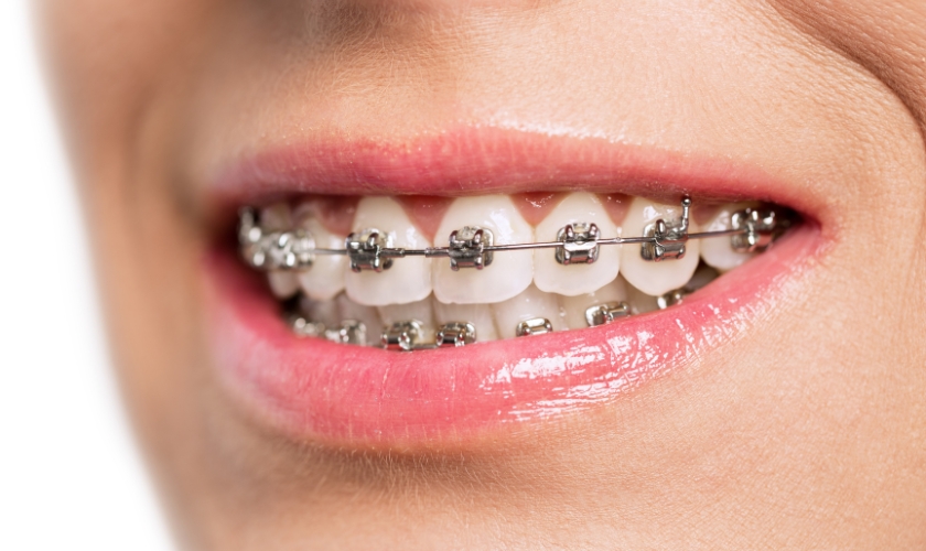 Unlocking the Secrets of Traditional Braces: Your Ultimate Guide to Straightening Teeth