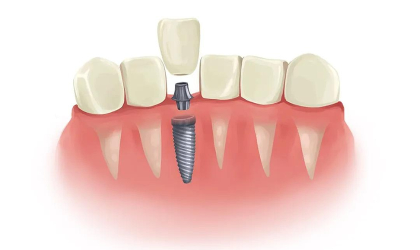 Can You Chew Hard Food with Dental Implants?