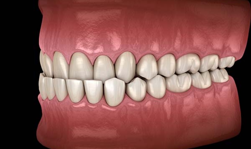 Say Goodbye to Your Underbite: Effective Treatment Options and Solutions