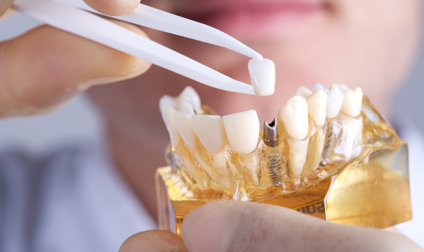 Dental Implants Are They the Right Choice for You