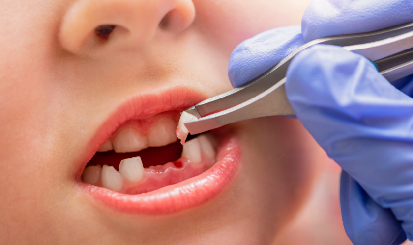 What To Eat After Tooth Extraction?