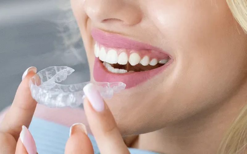 Unlocking the Benefits of Invisalign: A Comprehensive Overview